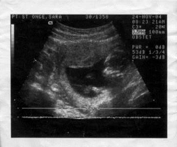 Saras-baby-sonogram-photo