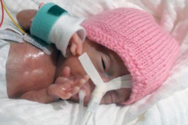 smallest-ever-prem-baby-to-survive-was-only-31-cm-long
