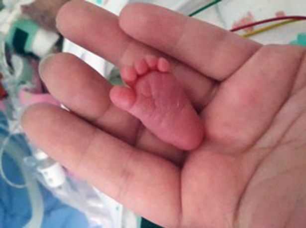 smallest-ever-prem-baby-to-survive-was-only-31-cm-long2